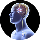  Estimulação Cerebral Profunda Deep Brain Stimulation (DBS)