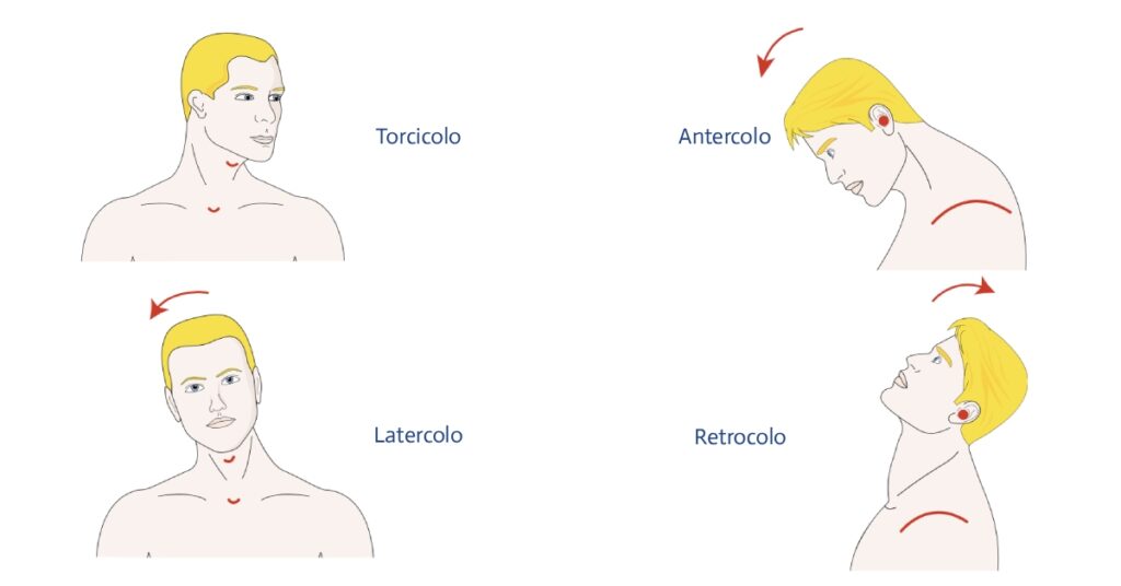 Distonia Cervical ou Torcicolo Espasmódico: o que é e como identificar