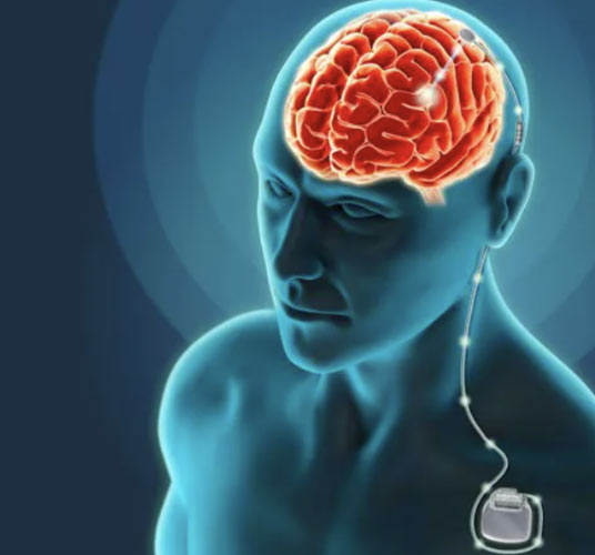 Como a doença de Parkinson se espalha no cérebro? - Blog Cirurgia