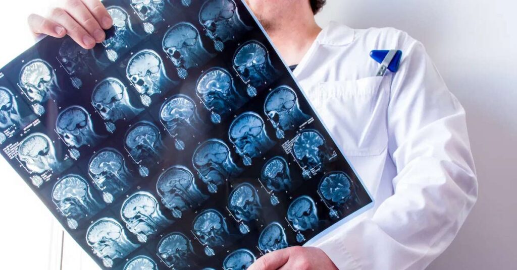 Doença de Parkinson_ Atuação do Neurologista na Personalização do Tratamento